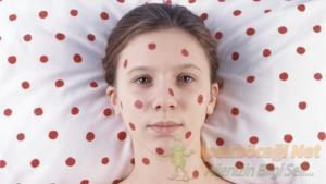Çocuk Hastalıkları ve Tedavileri – Kızamık